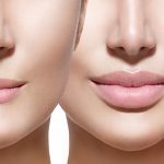 Lip Fillers Before and After Photos Results and Key Facts Today