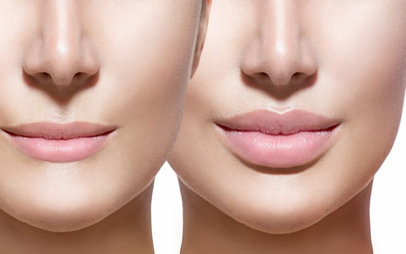 Lip Fillers